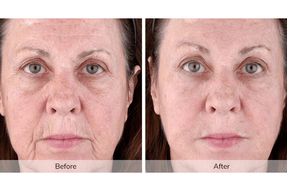 The At-Home Tool That Uses NASA Technology Research to Eliminate Wrinkles -  NewBeauty