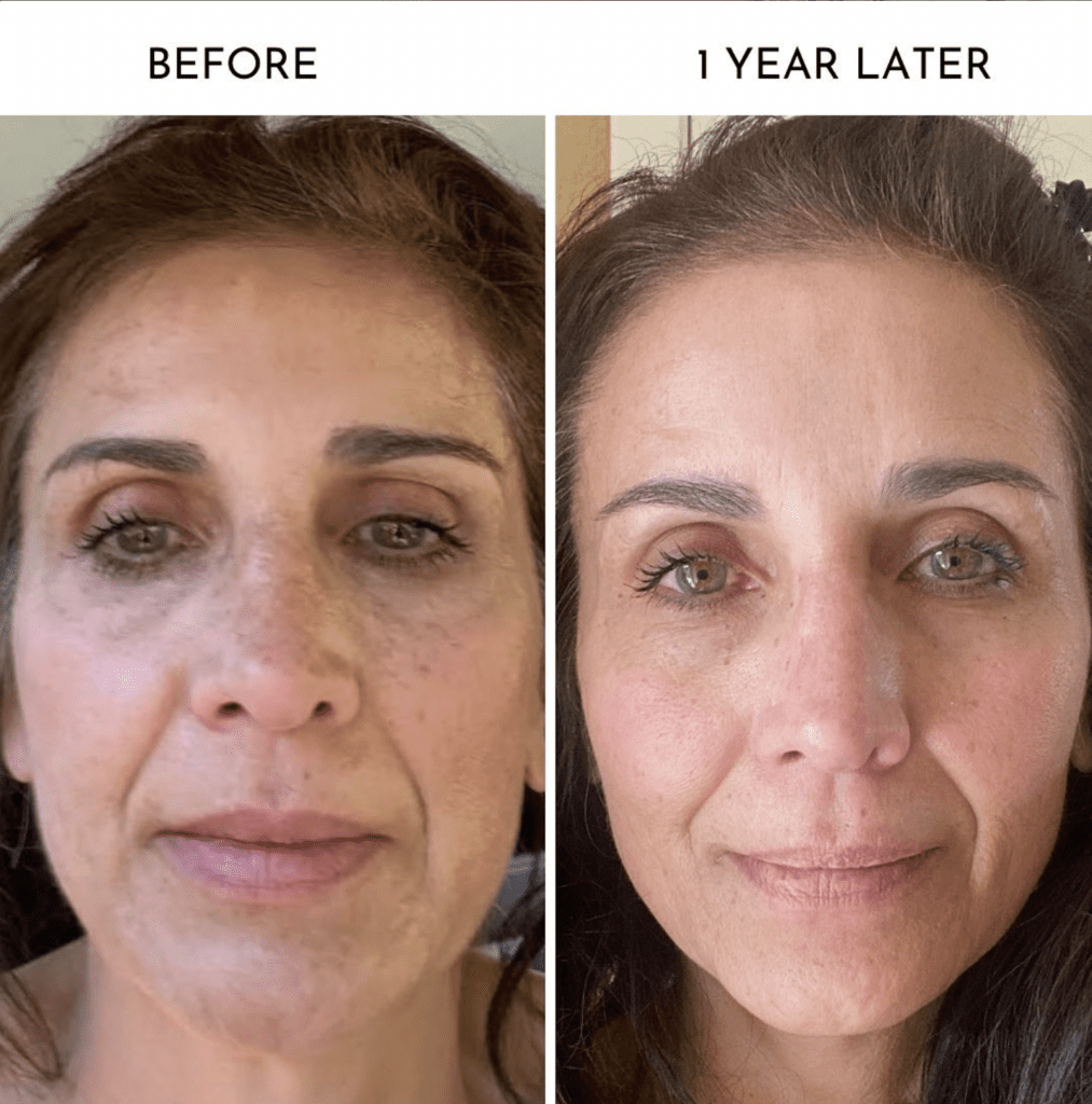 Microneedling Earlier than and After: Your Final Magnificence Transformation