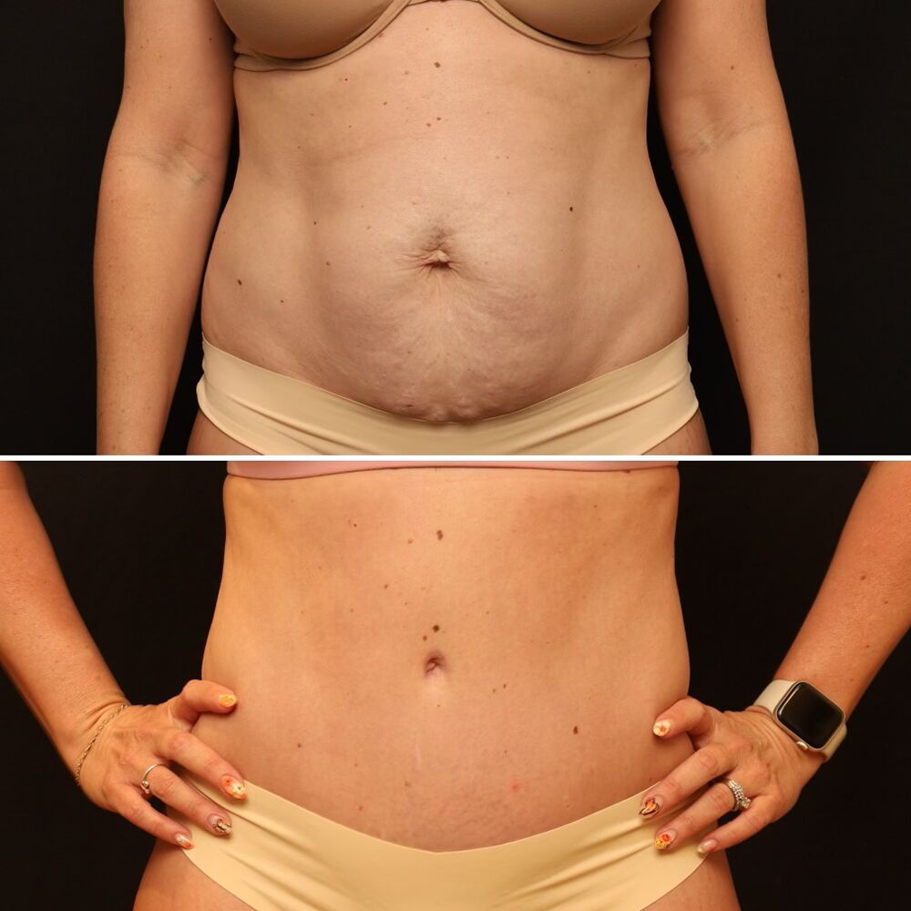 Before and after of a woman's midsection after tummy tuck