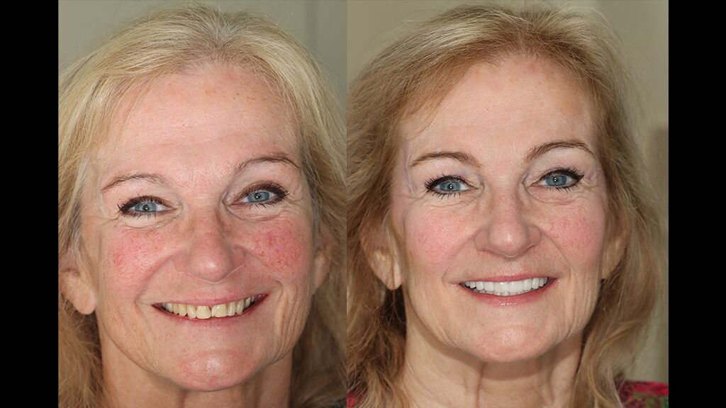 woman's smile makeover before and after