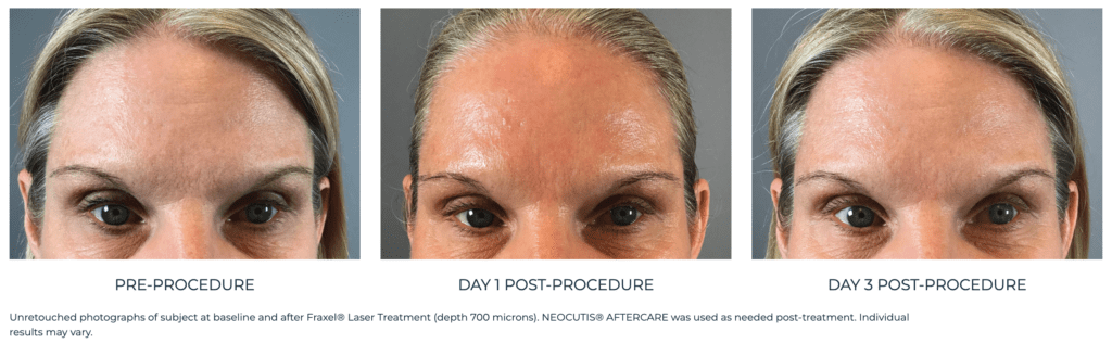 neocutis aftercare before-and-after results