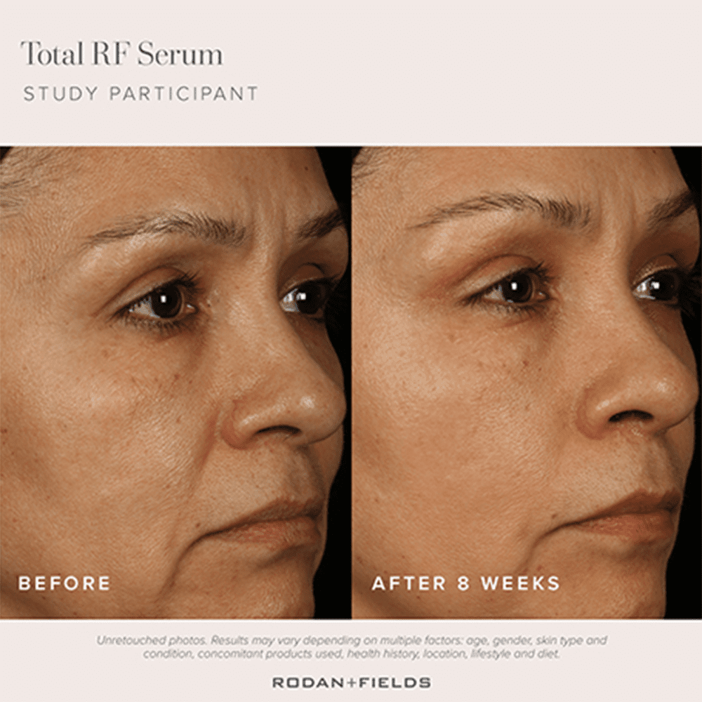 話題！ RODAN＋FIELDS☆塗るボトックス 若返りトータルRFセラム 楽天市場】【送料無料】ロダンアンドフィールズ 美容液 トータル
