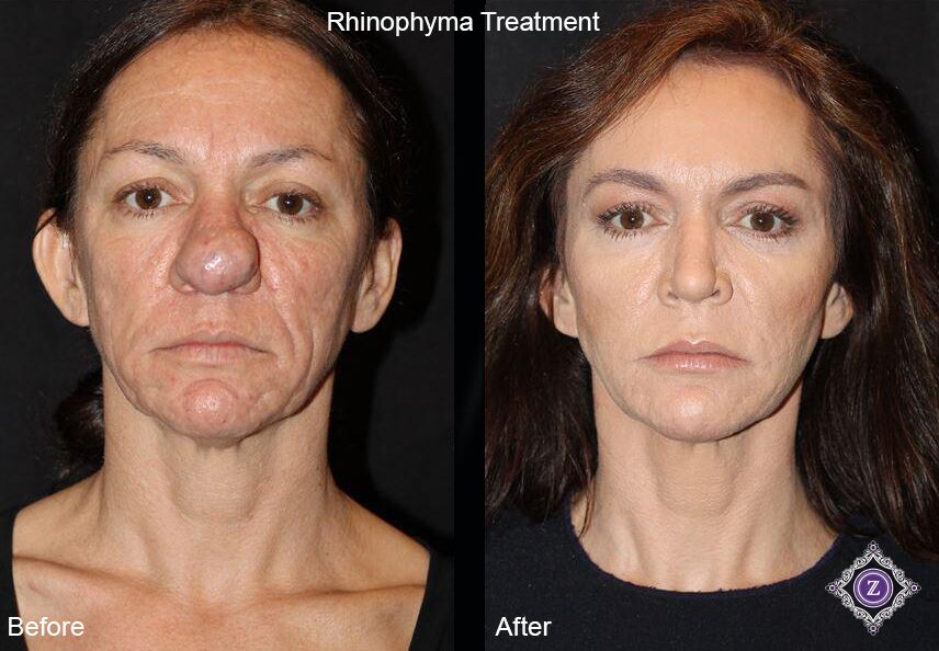 Mild Rhinophyma Pictures