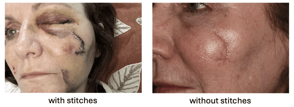 The Therapies That Helped One Lady Repair a Facial Scar With out Surgical procedure – Beauty