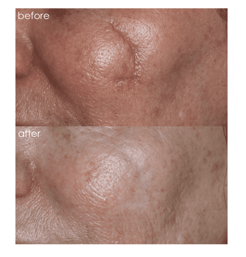 One Patient's Before & Afters 3 facial scar before and after