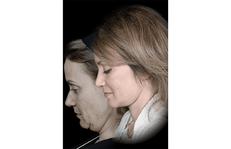 Why I Obtained a Necklift In My Early 50s – Beauty