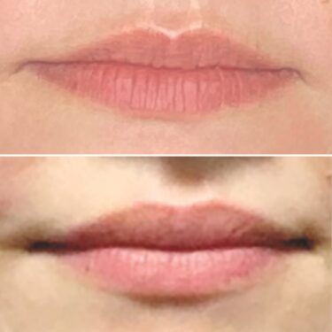 lip flip before and after using Botox to lift the Cupid's bow