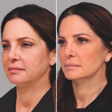 Extracción de grasa bucal antes y después de un paciente de 56 años para contornos juveniles con estiramiento facial y ascensor del cuello