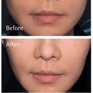 Masseter Botox Gallery: Before and After - NewBeauty
