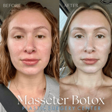 jaw slimming neurotoxin treatment masseter botox before and after