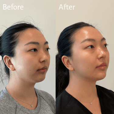 masseter botox before and after shows subtle jaw slimming