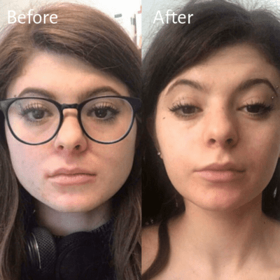 Masseter Botox Gallery: Before and After - NewBeauty