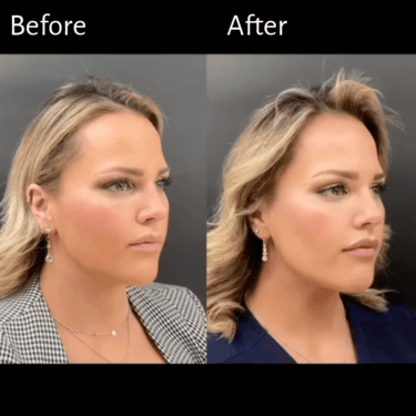 lower face neurotoxin treatment with masseter botox before and after