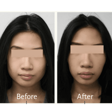 Masseter Botox Gallery: Earlier than and After – Beauty