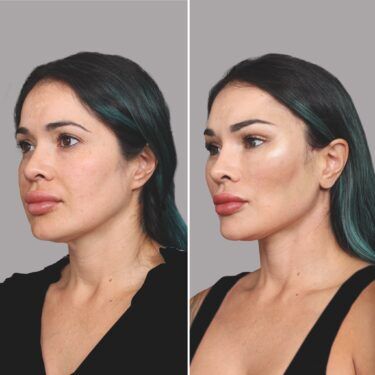 Extracción de grasa bucal antes y después de un paciente de 43 años con estiramiento facial y collar 