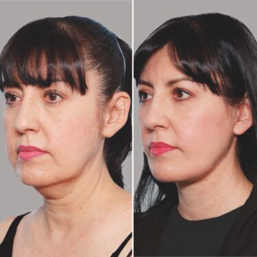 Extracción de grasa bucal antes y después para las mejillas definidas en un paciente de 53 años con estiramiento facial y transferencia de grasa