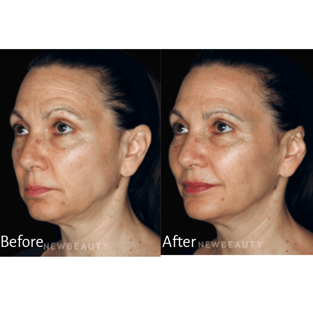 Dr. Day treated this patient with Botox, chemical peels and Juvéderm for a refreshed look.