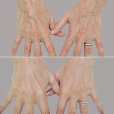 Are Your Arms Giving You Away? Consultants Break Down Hand Filler – Beauty