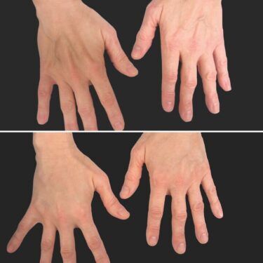 Dr. Loss inyectó un relleno de mano de radiosé en este paciente