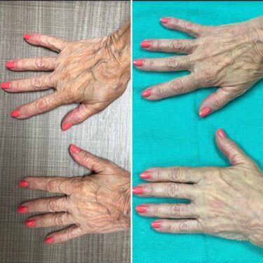 Inyecciones de relleno de mano con RadioSse antes y después