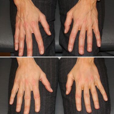Dr. Madnani Filler de mano antes y después