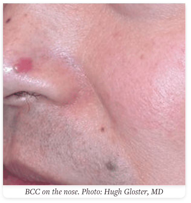 The best way to Inform the Distinction Between Pores and skin Most cancers and a Pimple