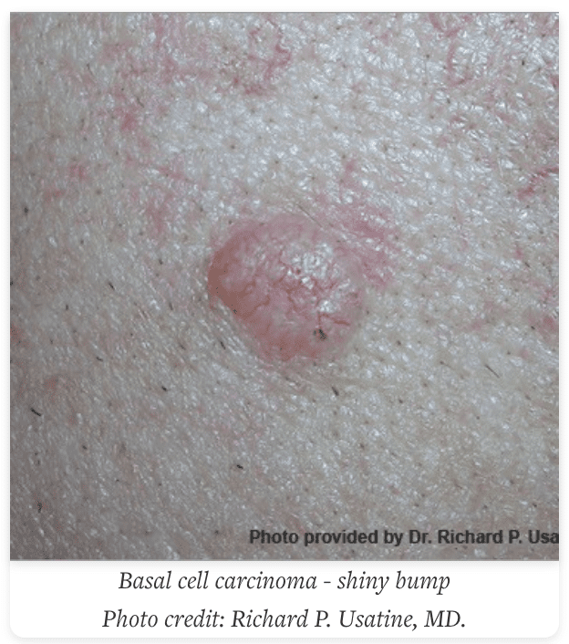 basal cell carcinoma
