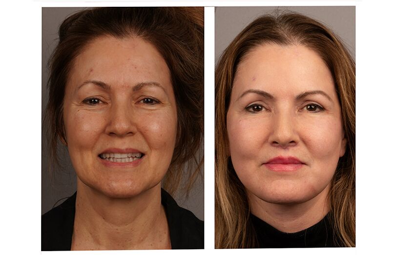 I Had a Facelift Throughout Menopause and Lastly Felt Seen Once more – Beauty