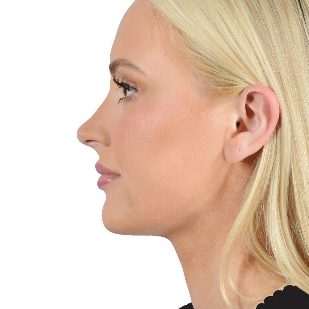 chin lipo after