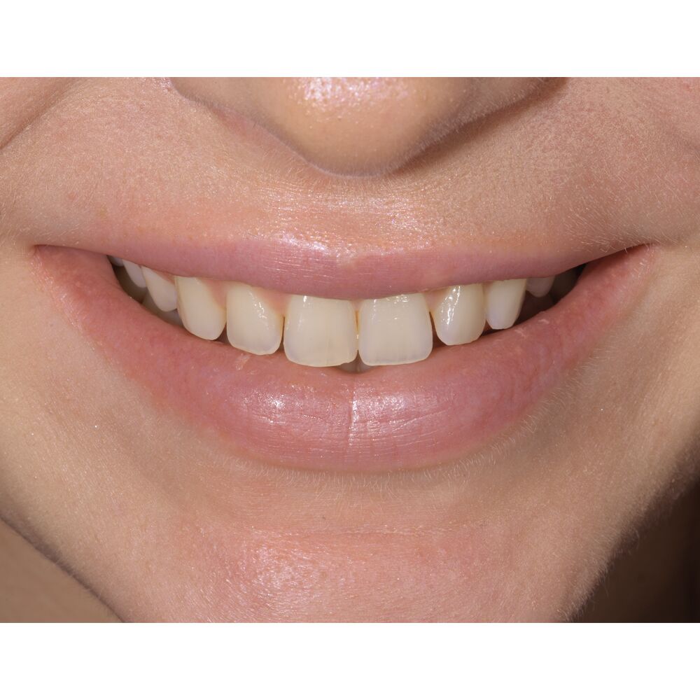 veneers before