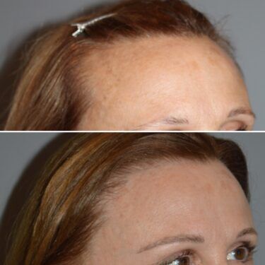 Atlanello female patient's hair before and after