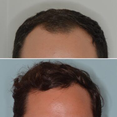 Hair Transplant Patient Fua
