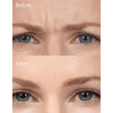 Botox Before and After
