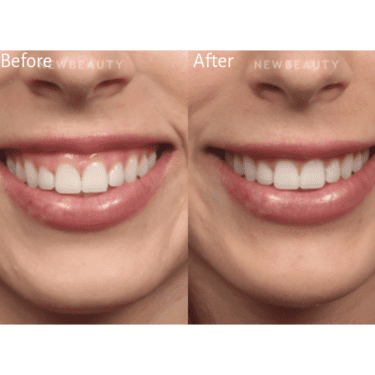 Botox Before and After
