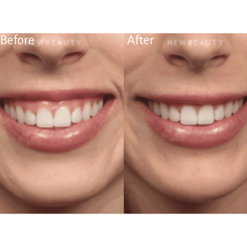 Botox Transformations: Before and After Photo Gallery