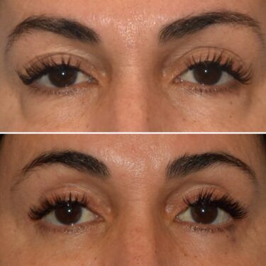 upper eyelidlift Dr. Andrew Peredo before and after blepharoplasty