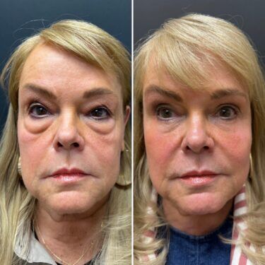 Dr. Asaadi Upper and Lower blepharoplasty