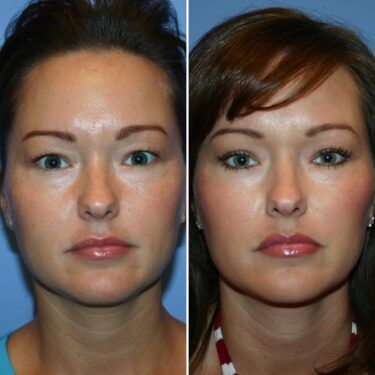 Dr. Bomer eyelift before and after gallery