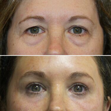 blepharoplasty with laser skin resurfacing before and after