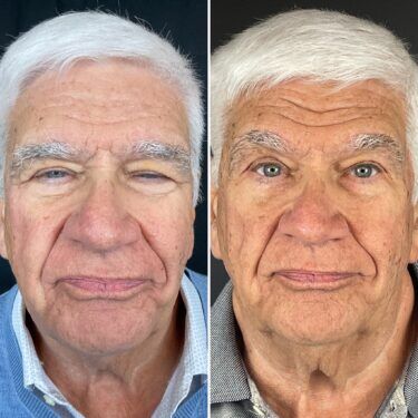 Male patient before and after blepharoplasty gallery