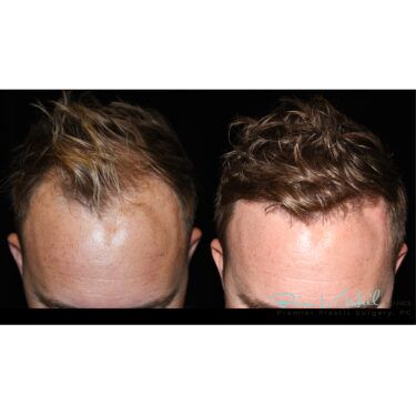 Hair restoring results before and after