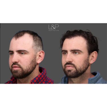 L & P Male Patient Hair Transplant Results