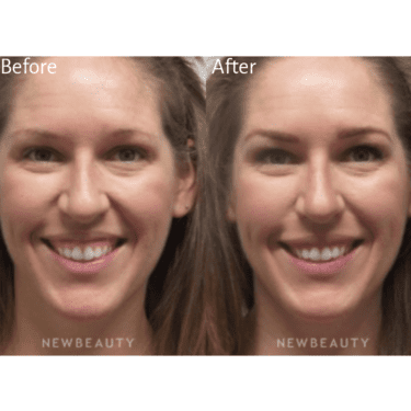 Botox Before and After