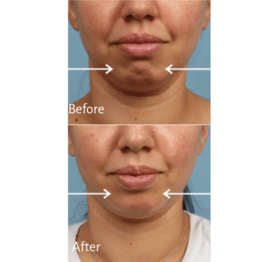 Botox Before and After