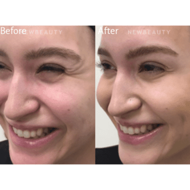 Botox Before and After