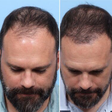 Dr. Wise Hair Transplant Male Patient Before and After