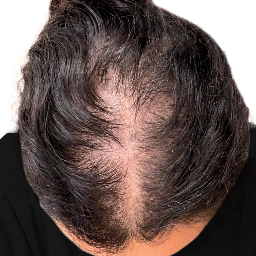 Before Nutrafol