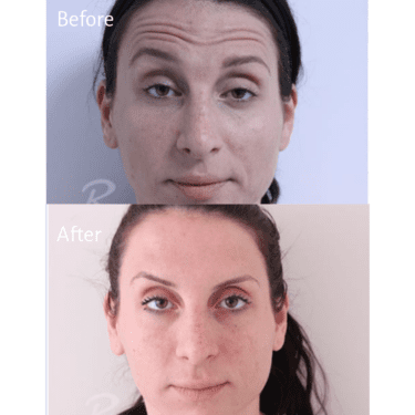 Botox Before and After