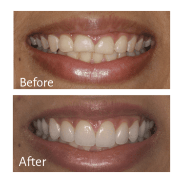 Veneers Before and After