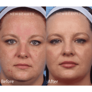 Microneedling before and after Image / Kelly Bomer